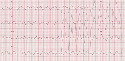 Hyperkalemia peaked T waves