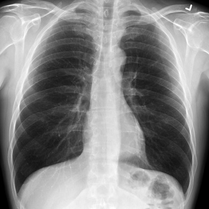 CXR
