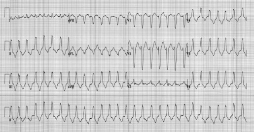 RVOT V-Tach