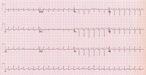 Sinus tachycardia