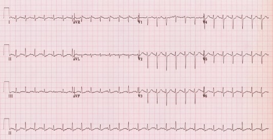 Sinus tachycardia