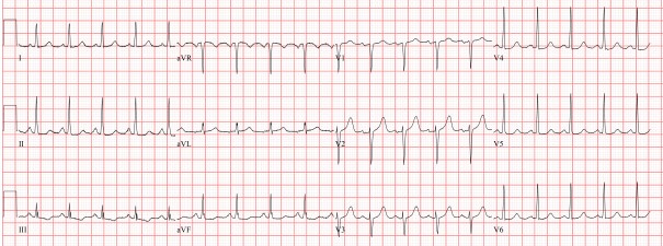 Sinus tachycardia 115