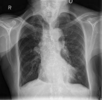 CXR