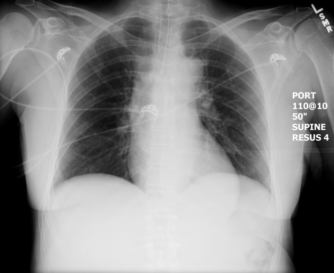 Normal Post-Intubation CXR