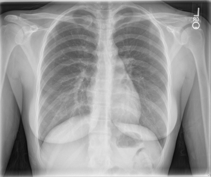 normal-female-chest