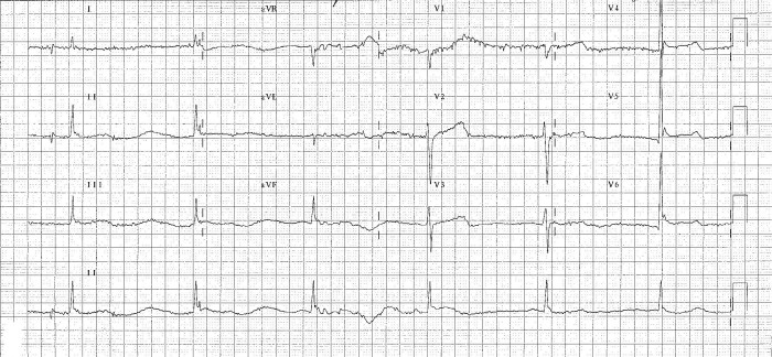 hypothermia-shiver-artefact