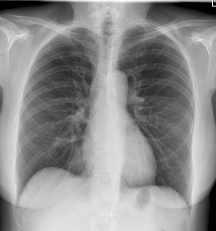 normal female CXR radiopedia