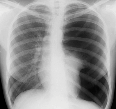 CXR Tension ptx