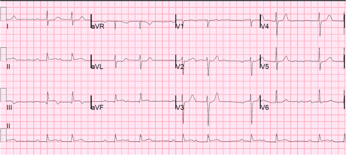 mobitz-1-stemi