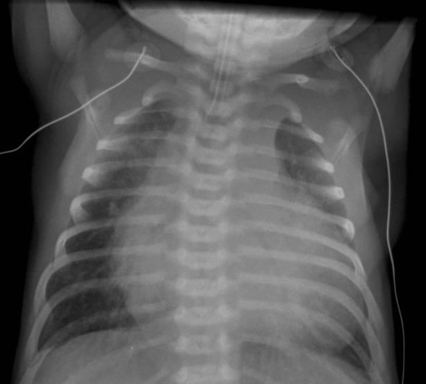 chf-neonate-post-intubation