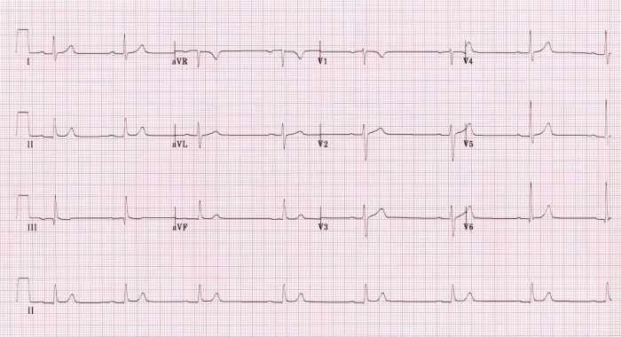 sinus brady with 1st degree hb