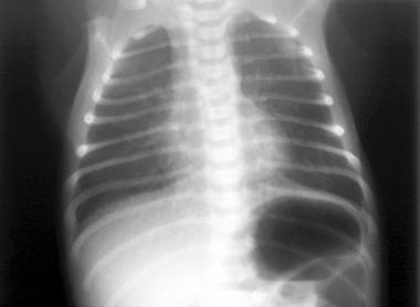 Normal neonatal CXR