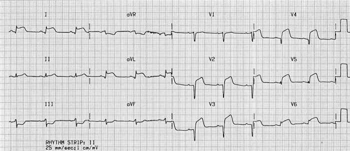 anterolateral STEMI