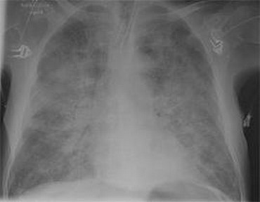 CHF post intubtation