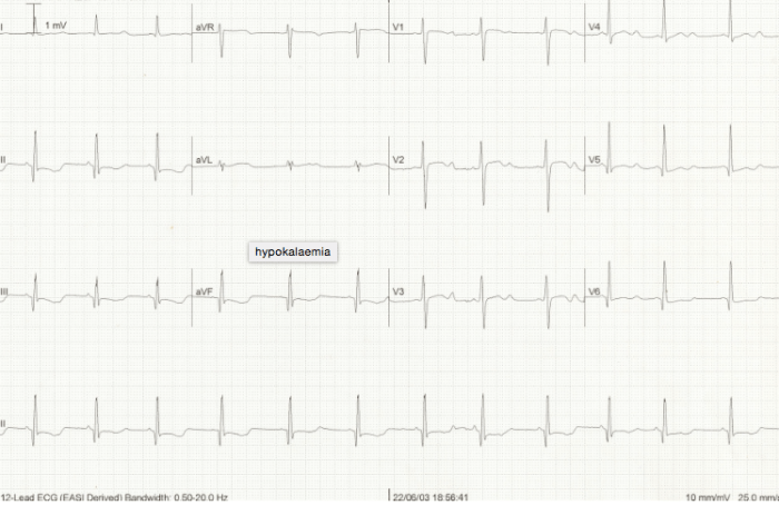Hypokalemia ECG