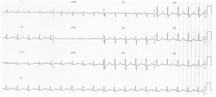 Long QT ECG