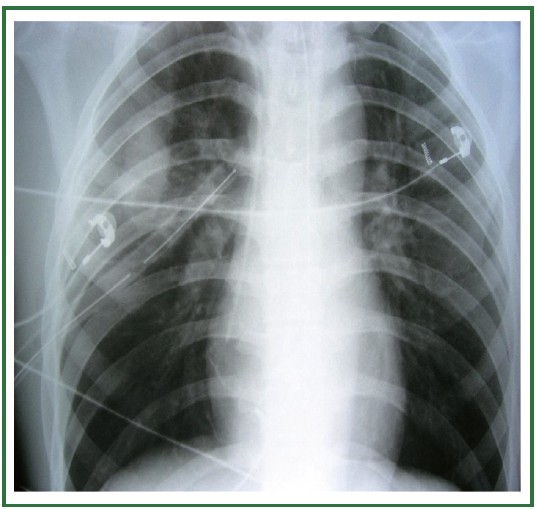 R chest tube post PTX