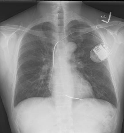 CXR with normal ICD
