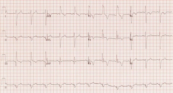 Massive PE ECG