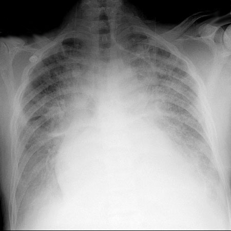 posttestQ2pulmonaryedema