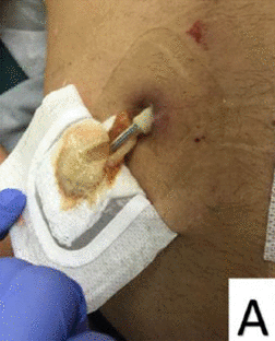 driveline infection A