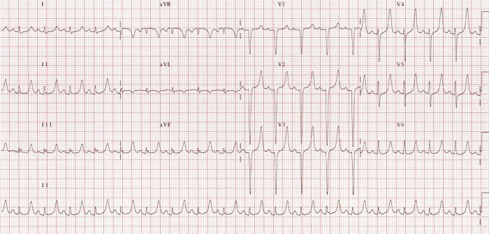 hyperkalemia narrow QRS