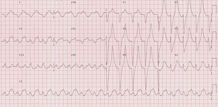 hyperkalemia