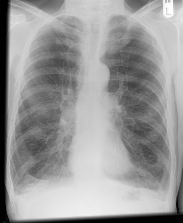 Geriatric Trauma CXR