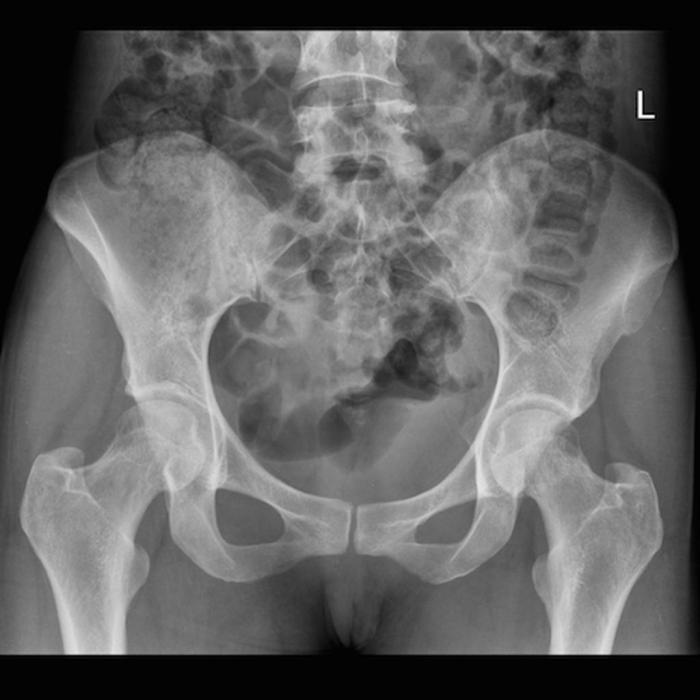 Geriatric Trauma Pelvic XR