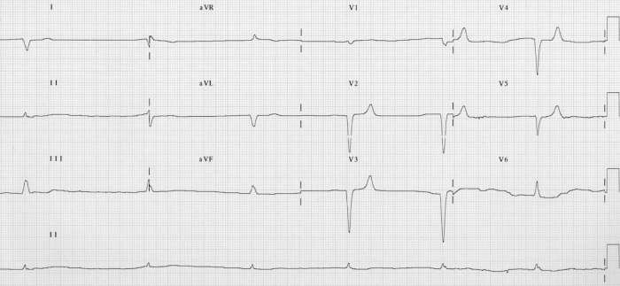 ECG-Hyperkalemia-junctional-bradycardia-potassium-8